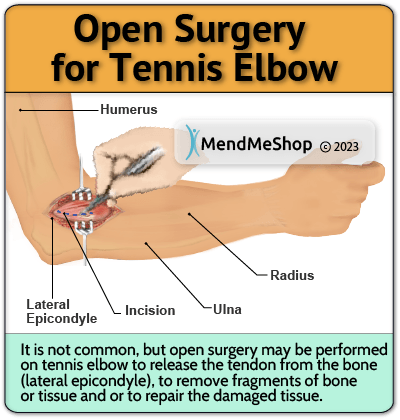 Tennis Elbow open elbow surgery - 90% can heal through conservative treatment methods