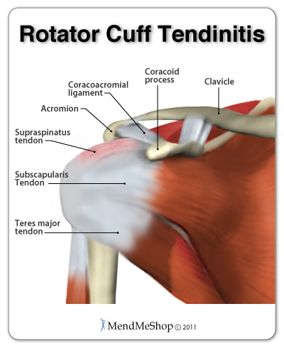 Rotator cuff tendinitis often caused by wear & tear or acute injury