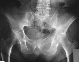 Hip/Groin Xray